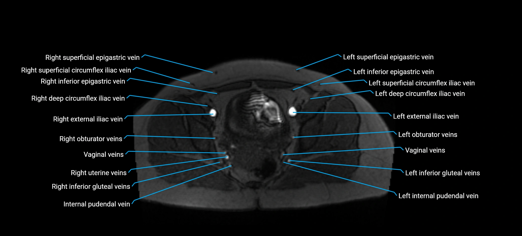 MRV abdomen pelvis & lower limb axial cross sectional anatomy labelled MRI image 168 (1).webp